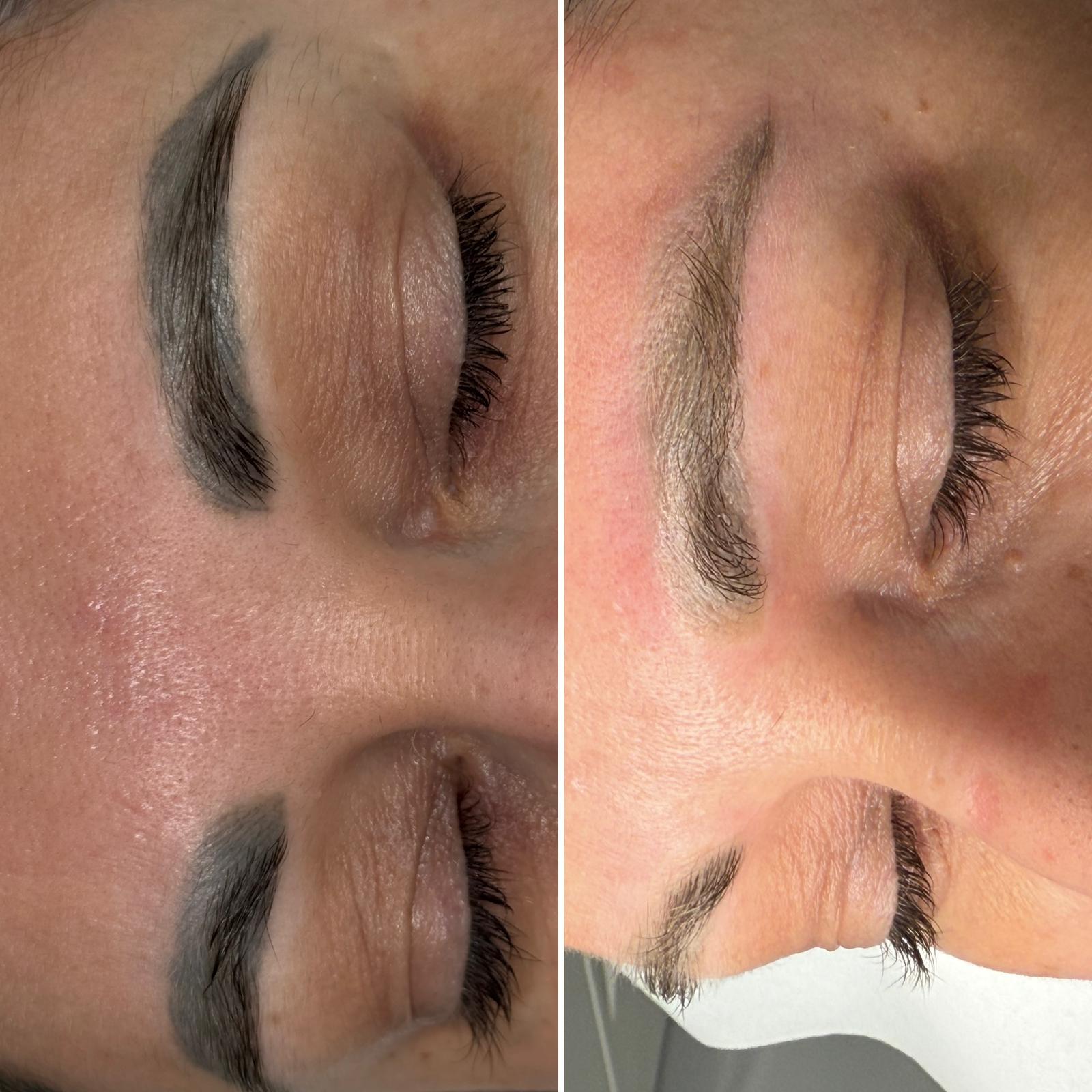 Tratament Laser nd:Yag Q-switched