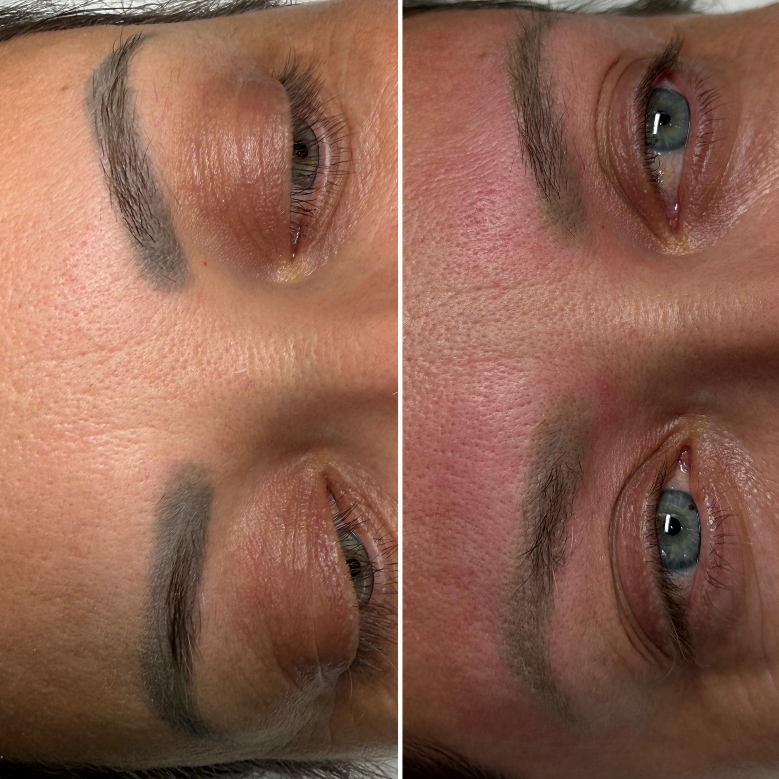 Îndepărtare tatuaj laser procedură profesională